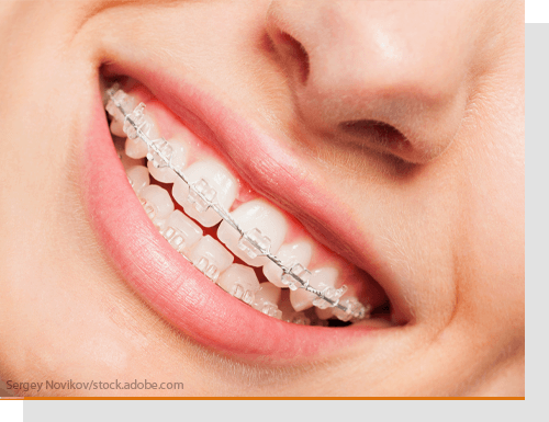 Regelmige Tragezeiten Zahnspangen