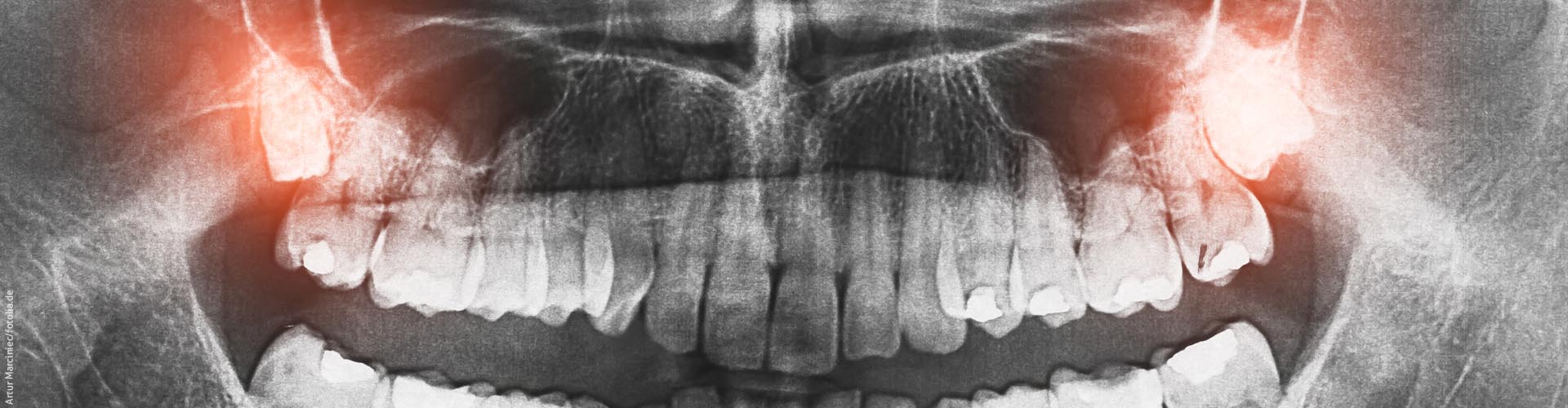 Rntgen des Kiefers als Panoramaaufnahme
