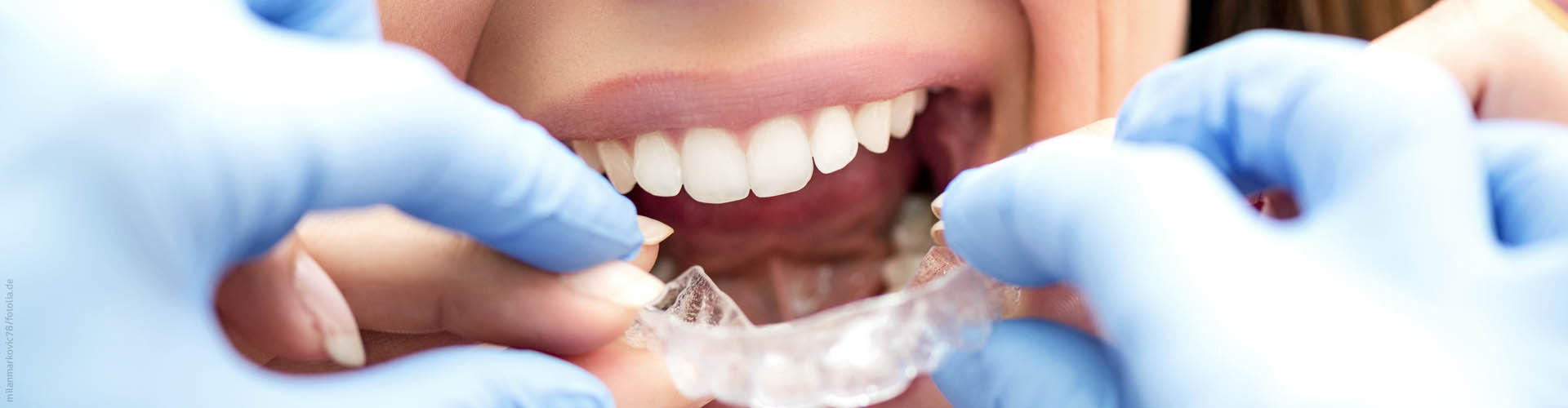Probleme mit Zahnspangen, Alignern, und Zahnschienen