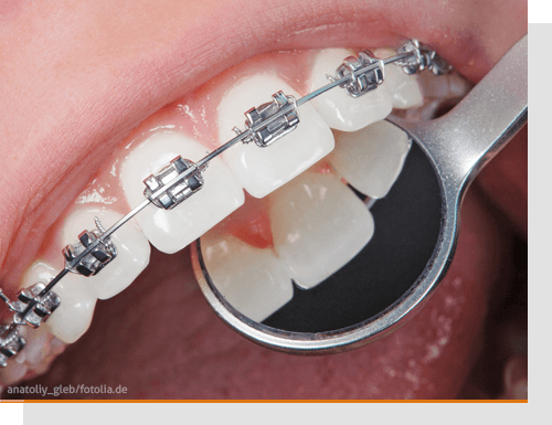 Probleme mit festen Zahnspangen