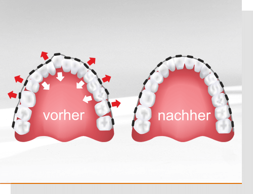 Vorher - nachher mit Zahnspange