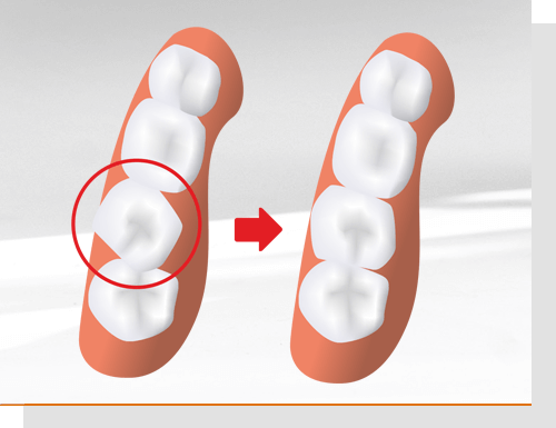 Zahnbewegung Torque und kippende Bewegung