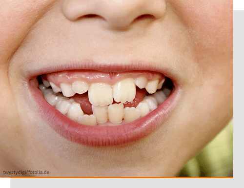 Zahnfehlstellungen bei Kindern